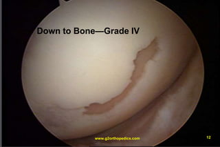 Down to Bone—Grade IV
www.g2orthopedics.com 12
 