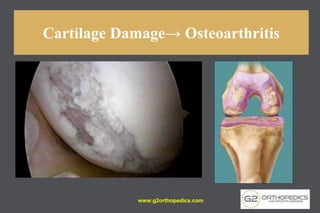 Cartilage Damage→ Osteoarthritis
www.g2orthopedics.com
 