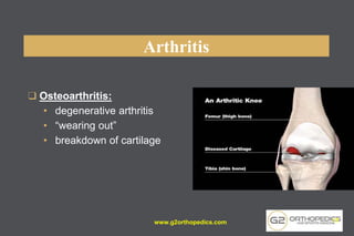 Arthritis
❑ Osteoarthritis:
• degenerative arthritis
• “wearing out”
• breakdown of cartilage
www.g2orthopedics.com 17
 