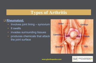 Types of Arthritis
❑ Rheumatoid:
• Involves joint lining – synovium
• It swells
• invades surrounding tissues
• produces chemicals that attack
the joint surface
www.g2orthopedics.com 18
 