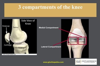 3 compartments of the knee
Medial Compartment
Lateral Compartment
www.g2orthopedics.com
 