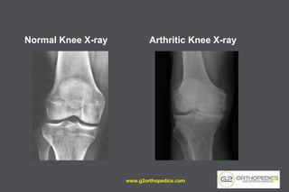 Normal Knee X-ray Arthritic Knee X-ray
www.g2orthopedics.com 30
 