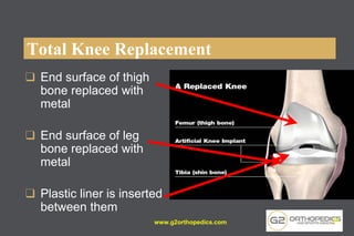Total Knee Replacement
❑ End surface of thigh
bone replaced with
metal
❑ End surface of leg
bone replaced with
metal
❑ Plastic liner is inserted
between them
www.g2orthopedics.com 31
 