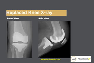 Replaced Knee X-ray
Front View Side View
www.g2orthopedics.com 32
 