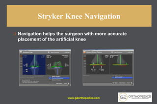Stryker Knee Navigation
❑ Navigation helps the surgeon with more accurate
placement of the artificial knee
www.g2orthopedics.com
 