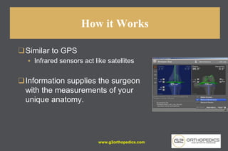 How it Works
❑Similar to GPS
▪ Infrared sensors act like satellites
❑Information supplies the surgeon
with the measurements of your
unique anatomy.
www.g2orthopedics.com
 