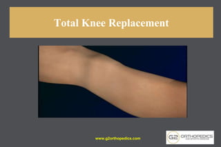 Total Knee Replacement
www.g2orthopedics.com
 