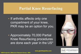 Partial Knee Resurfacing
▪ If arthritis affects only one
compartment of your knee,
PKR may be an option for you.
▪ Approximately 70,000 Partial
Knee Resurfacing procedures
are done each year in the US*
*2008 Projection, Millennium Research Group, 2005.
www.g2orthopedics.com
 