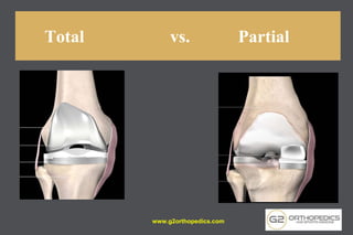 Total vs. Partial
www.g2orthopedics.com
 