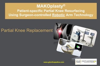 MAKOplasty®
Patient-specific Partial Knee Resurfacing
Using Surgeon-controlled Robotic Arm Technology
Partial Knee Replacement
www.g2orthopedics.com 47
 