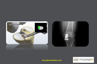 www.g2orthopedics.com 53
 
