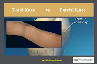 Total Knee vs. Partial Knee
www.g2orthopedics.com
 