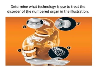 Determine what technology is use to treat the
disorder of the numbered organ in the illustration.
 