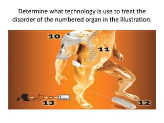 Determine what technology is use to treat the
disorder of the numbered organ in the illustration.
 