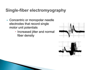  Concentric or monopolar needle
electrodes that record single
motor unit potentials
 Increased jitter and normal
fiber density
 