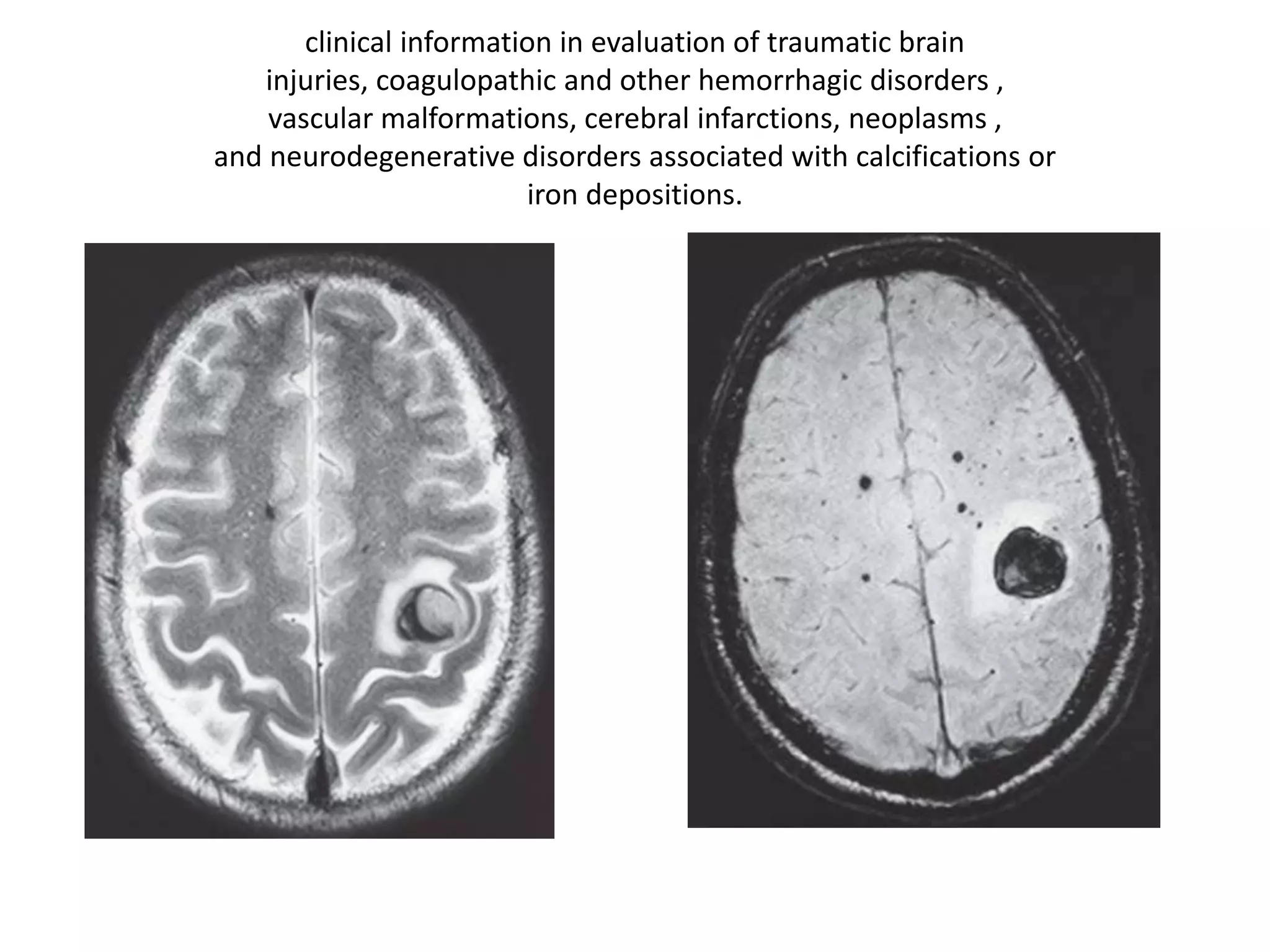 clinical information in evaluation of traumatic brain
injuries, coagulopathic and other hemorrhagic disorders ,
vascular malformations, cerebral infarctions, neoplasms ,
and neurodegenerative disorders associated with calcifications or
iron depositions.
 