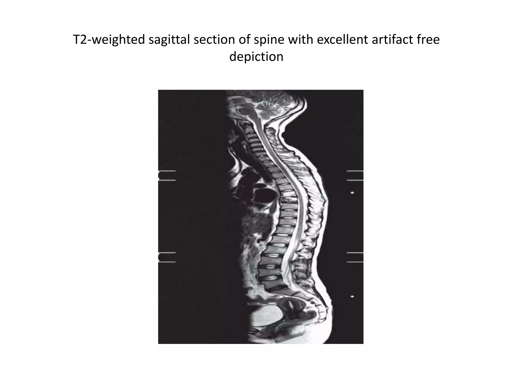 T2-weighted sagittal section of spine with excellent artifact free
depiction
 