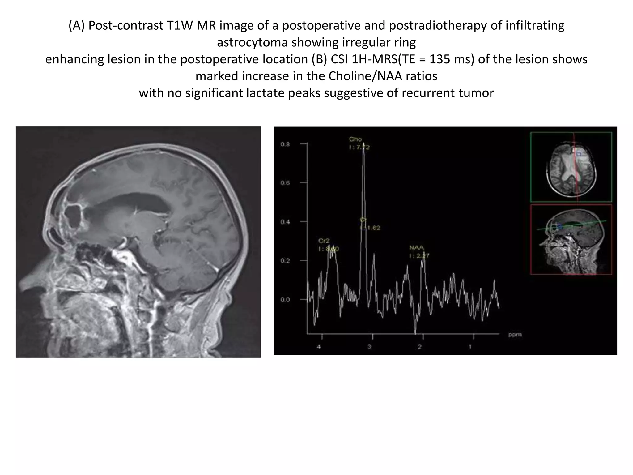 (A) Post-contrast T1W MR image of a postoperative and postradiotherapy of infiltrating
astrocytoma showing irregular ring
enhancing lesion in the postoperative location (B) CSI 1H-MRS(TE = 135 ms) of the lesion shows
marked increase in the Choline/NAA ratios
with no significant lactate peaks suggestive of recurrent tumor
 