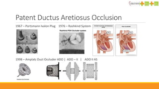 Patent Ductus Aretiosus Occlusion
1967 – Portsmann Ivalon Plug 1976 – Rashkind System
1998 – Amplatz Duct Occluder ADO | ADO – II | ADO II AS
 