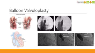 Balloon Valvuloplasty
 