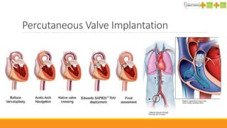 Percutaneous Valve Implantation
 
