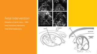 Fetal Intervention
Dilatation of Aortic Valve – 1991
Fetal Pulmonary Valvotomy
Fetal Atrial Septectomy
 