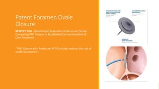 Patent Foramen Ovale
Closure
RESPECT Trial - Randomized Evaluation of Recurrent Stroke
Comparing PFO Closure to Established Current Standard of
Care Treatment
“ PFO Closure with Amplatzer PFO Occluder reduces the risk of
stroke occurrence.”
 