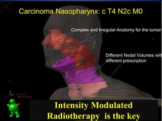 Intensity Modulated
Radiotherapy is the key
Complex and Irregular Anatomy for the tumor
Different Nodal Volumes with
diffe...