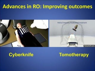 Advances in RO: Improving outcomes
Cyberknife Tomotherapy
 