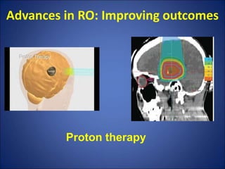 Advances in RO: Improving outcomes
Proton therapy
 