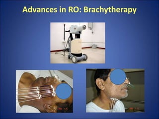 Advances in RO: Brachytherapy
 