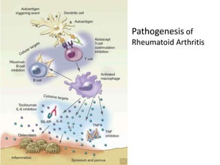 Advances in Rheumatoid Arthritis (RA) treatment | PPTX