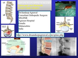  DR SANDEEP C AGRAWAL www.drsandeepagrawal.com Gondia Maharashtra  www.agrasenortho.com
1
http://www.drsandeepagrawal.com/spine.php
Dr.Sandeep Agrawal
Consultant Orthopedic Surgeon
MS,DNB
Agrasen Hospital
Gondia
Maharashtra
India
ADVANCES IN SPINE SURGERY 
Endoscopic and Minimally
Invasive Spine Surgery
 