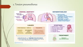 2. Tension pneumothorax
 