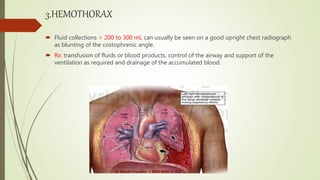 3.HEMOTHORAX
 Fluid collections > 200 to 300 mL can usually be seen on a good upright chest radiograph
as blunting of the costophrenic angle.
 Rx: transfusion of fluids or blood products, control of the airway and support of the
ventilation as required and drainage of the accumulated blood.
 