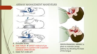 AIRWAY MANAGEMENT MANEVEURS
A. Occluded airway
B. JAW THRUST  SAFEST method of jaw
manipulation in a patient with suspected
CERVICAL SPINE INJURY
C. HEAD TILT-CHIN LIFT
OROPHYRANGEAL AIRWAY in
place to maintain airway
patency by elevating the base
of the tongue
 