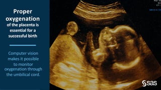 Proper
oxygenation
of the placenta is
essential for a
successful birth
Computer vision
makes it possible
to monitor
oxygen...