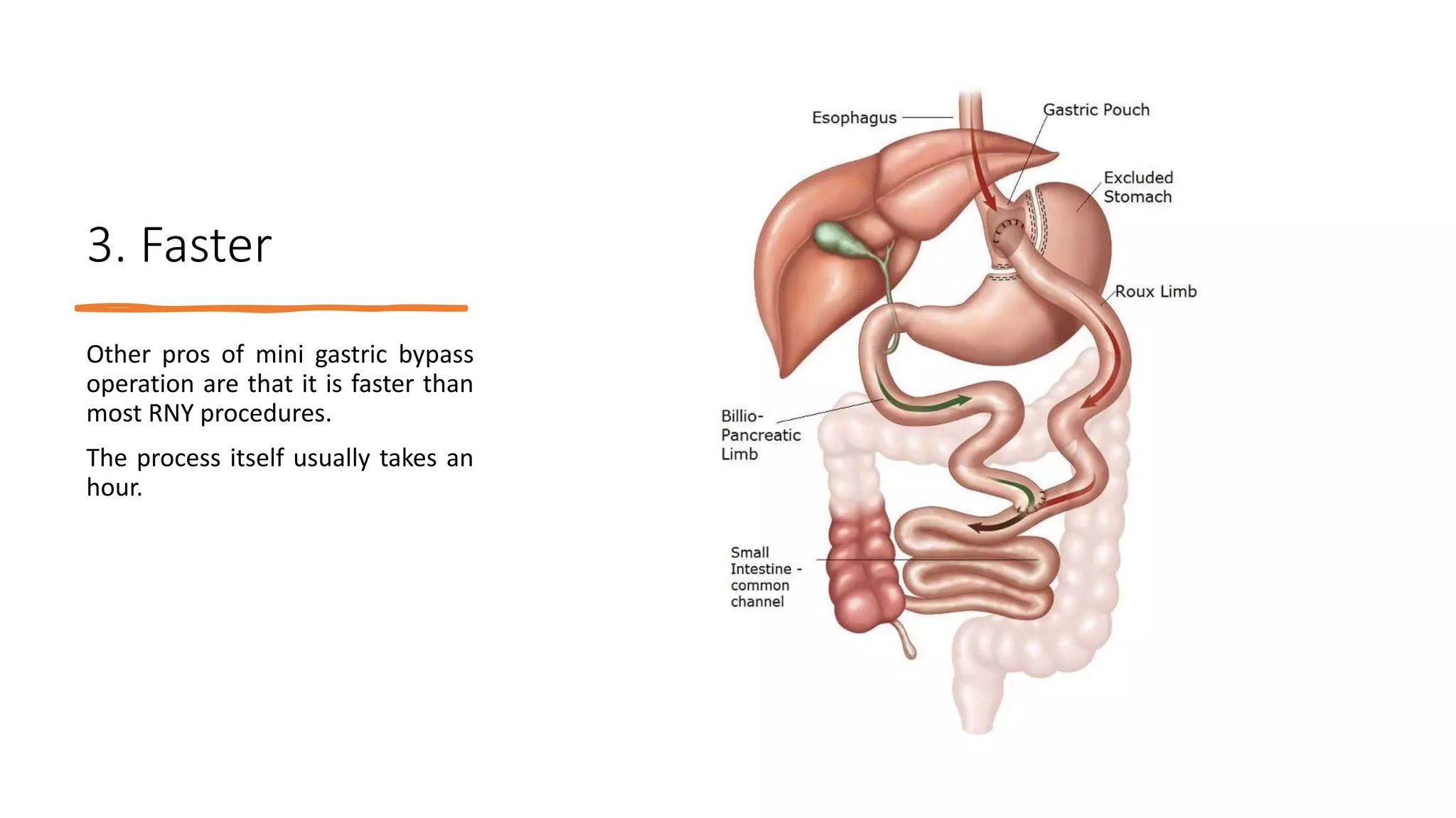 Advantages and Disadvantages of Mini Gastric Bypass Surgery | PPTX