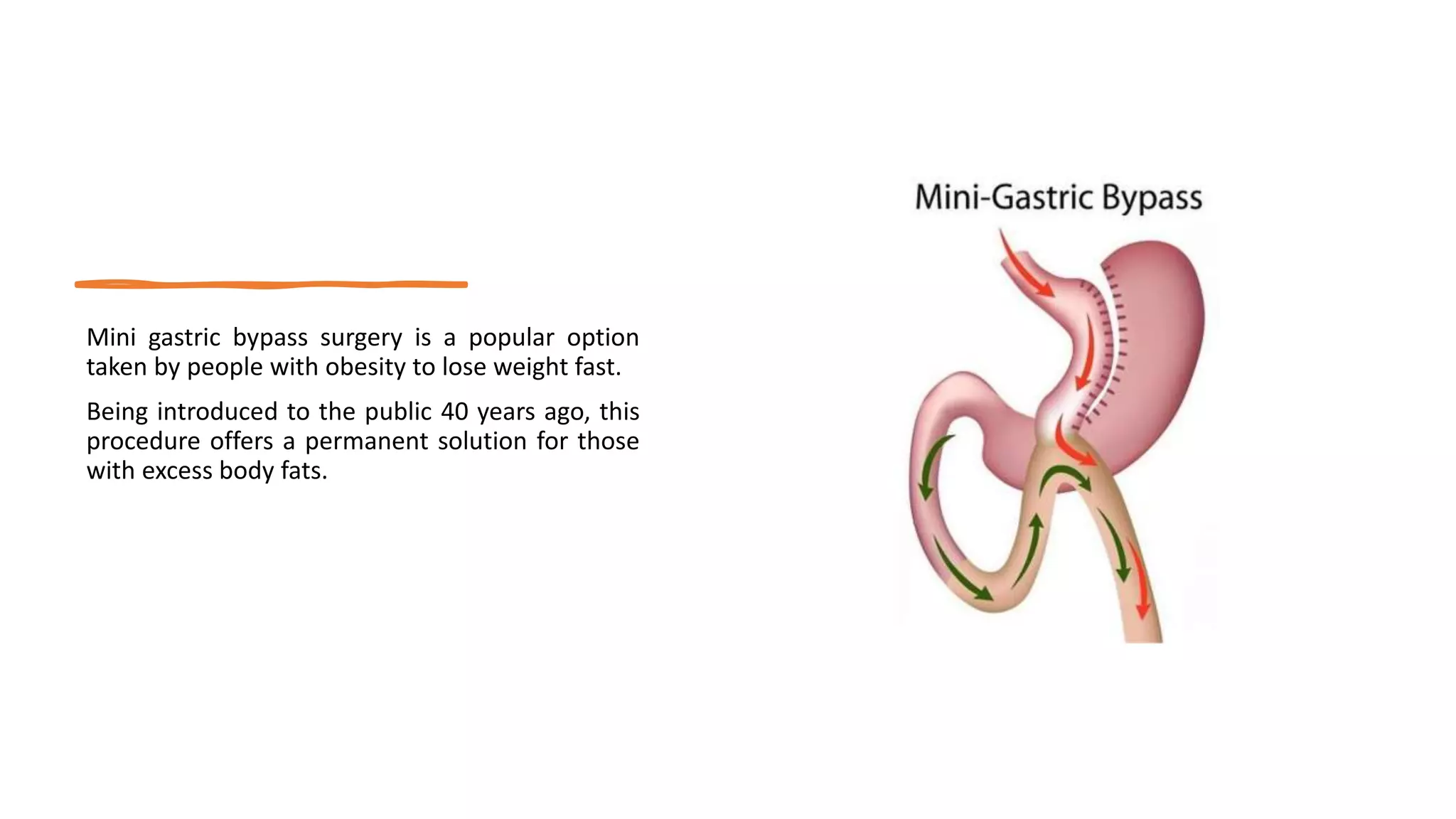 Advantages and Disadvantages of Mini Gastric Bypass Surgery | PPTX