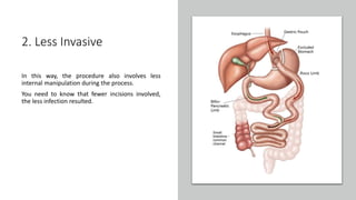 Advantages and Disadvantages of Mini Gastric Bypass Surgery | PPTX