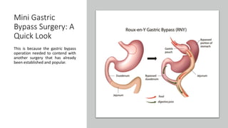 Advantages and Disadvantages of Mini Gastric Bypass Surgery | PPTX