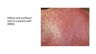 Diffuse Dew Drop Rash Adverse cutaneous drug reactions | PPTX