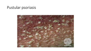 Pastu Rash Adverse cutaneous drug reactions | PPTX