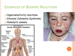 EXAMPLES OF BIZARRE REACTIONS
 Hypersensitivity reactions
 Stevens-Johnson’s Syndrome
 Hemolytic anemia
 