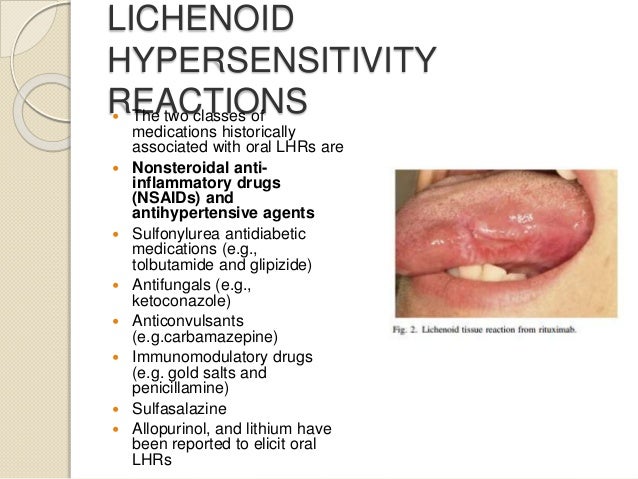 SEARCH AND BUY THIS PRODUCT Adverse drug reactions of oral cavity