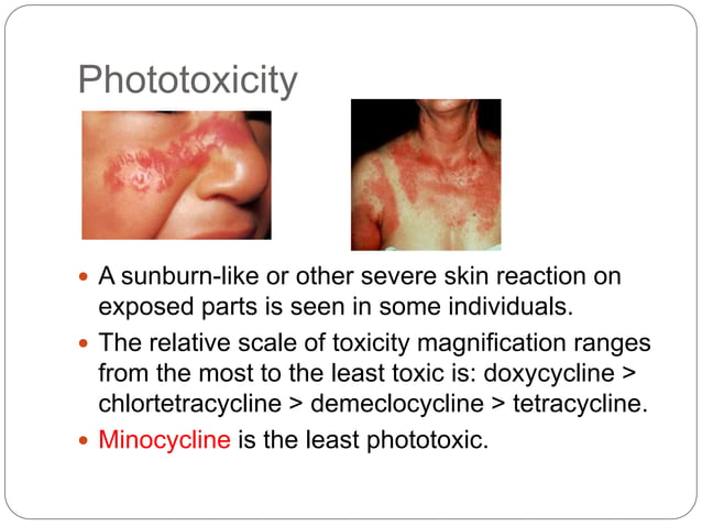 Adverse drug reactions of tetracycline antibiotics | PPTX