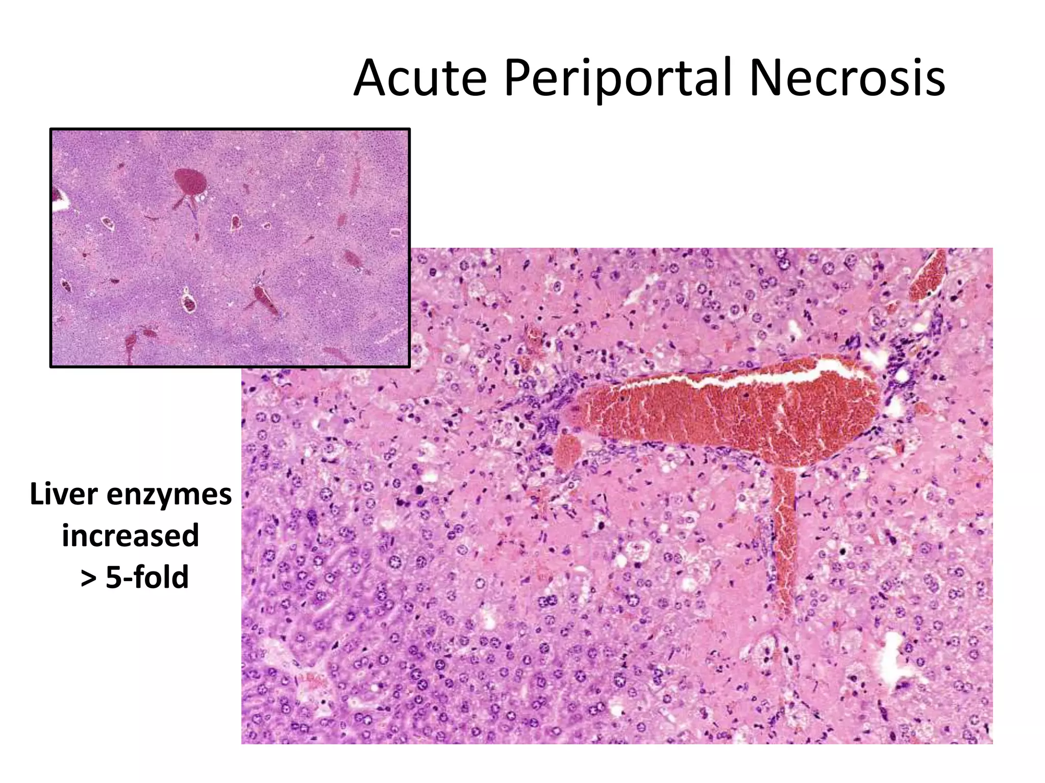 Acute Periportal Necrosis
Liver enzymes
increased
> 5-fold
 