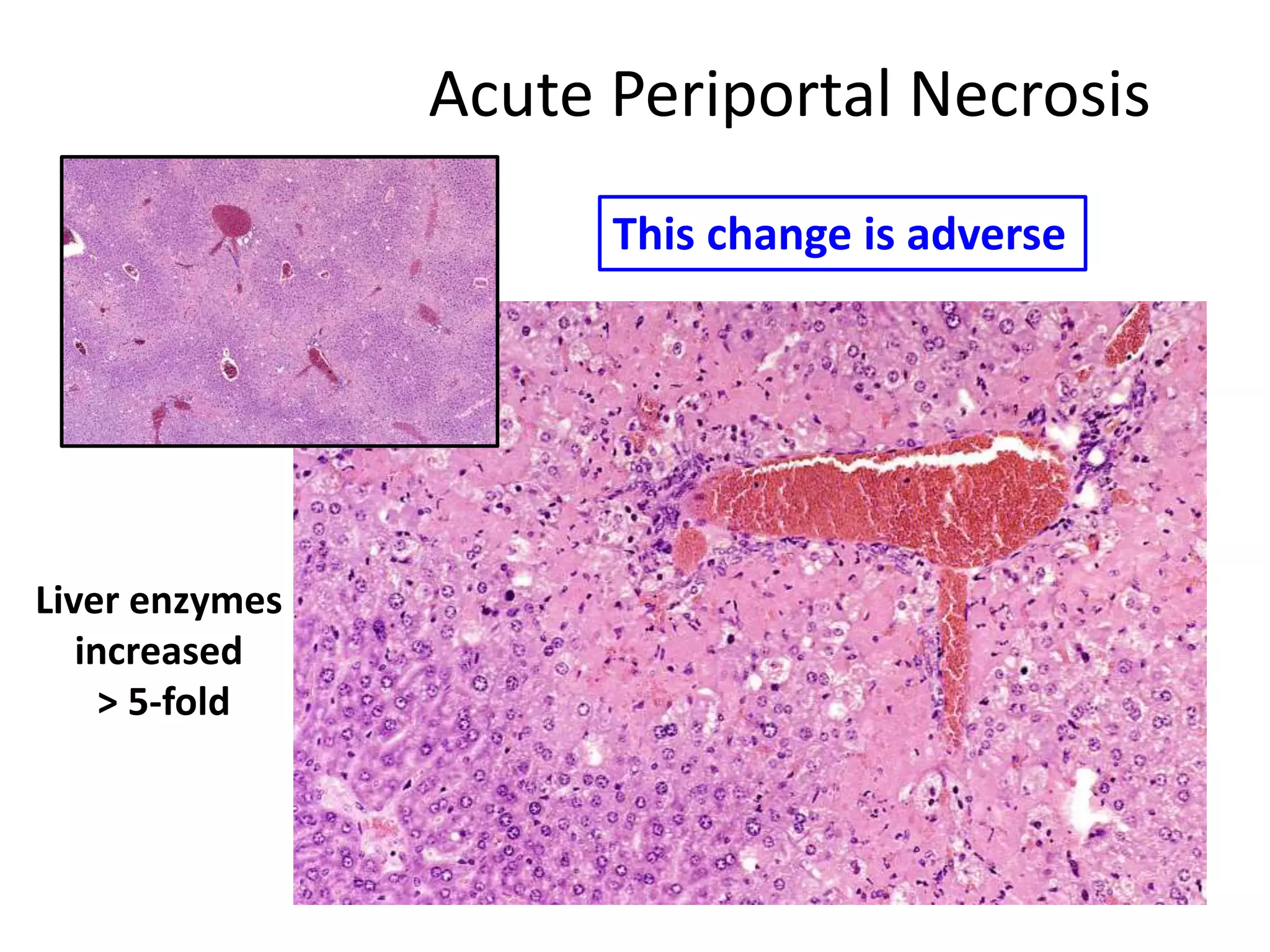 Acute Periportal Necrosis
This change is adverse
Liver enzymes
increased
> 5-fold
 