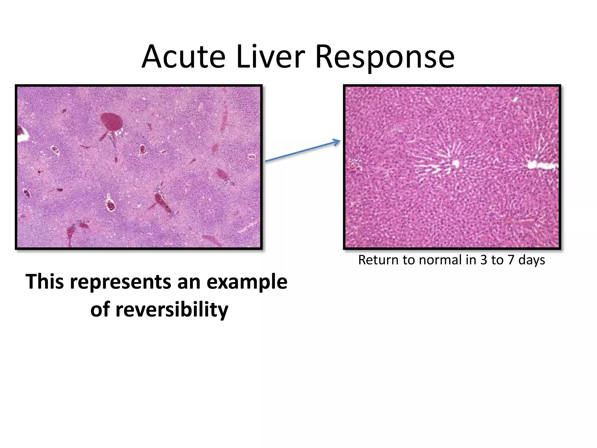 Acute Liver Response
Return to normal in 3 to 7 days
This represents an example
of reversibility
 