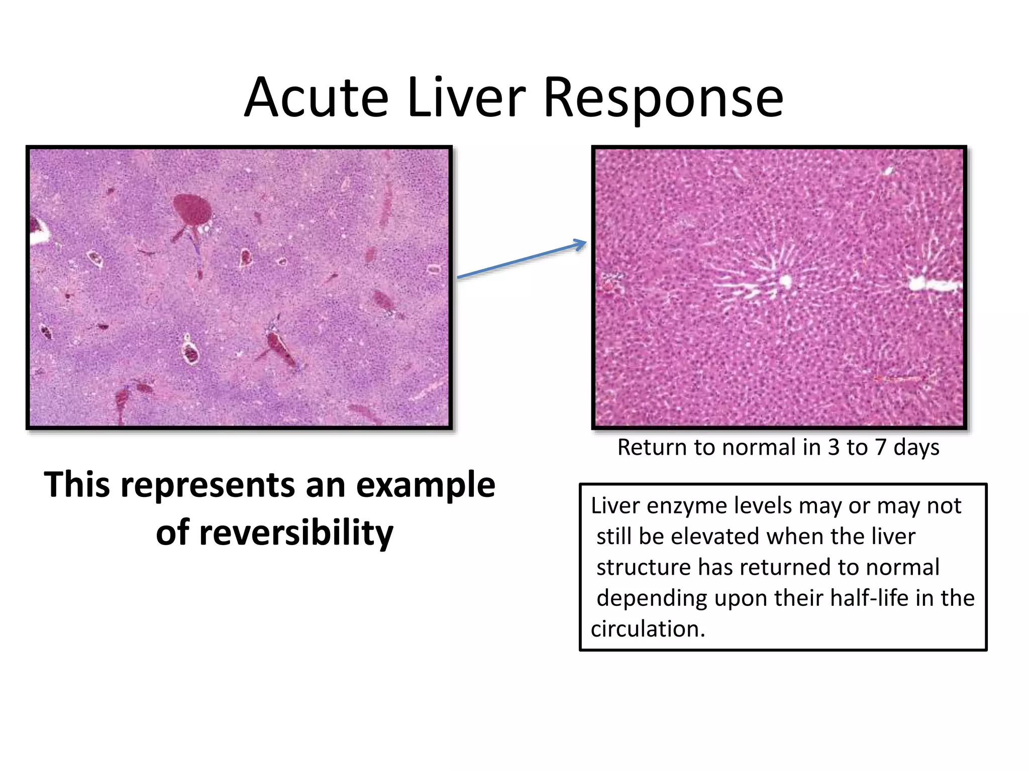 Acute Liver Response
Return to normal in 3 to 7 days
Liver enzyme levels may or may not
still be elevated when the liver
structure has returned to normal
depending upon their half-life in the
circulation.
This represents an example
of reversibility
 